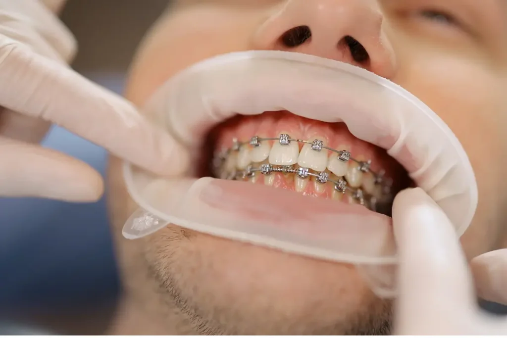 Patient undergoing Dentofacial Orthopedics Treatment