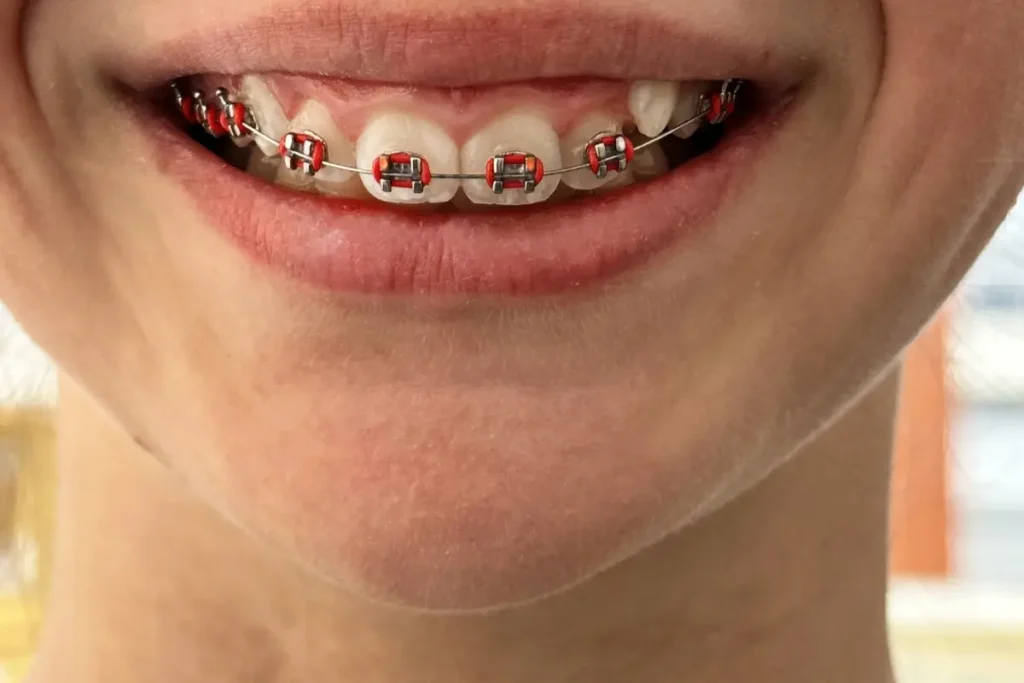 Colored Braces