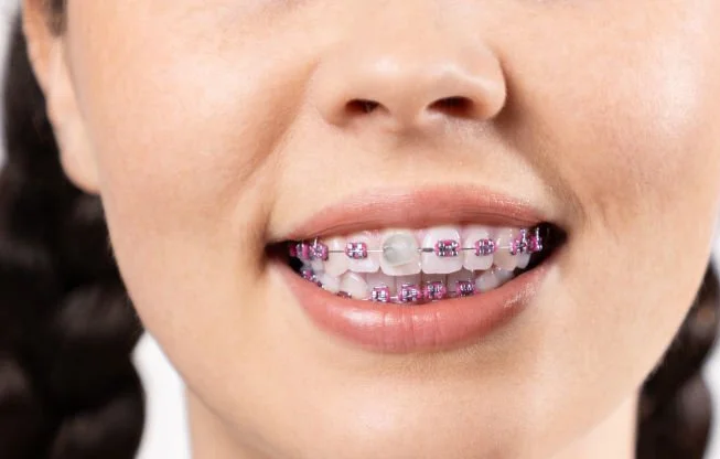 Braces wax