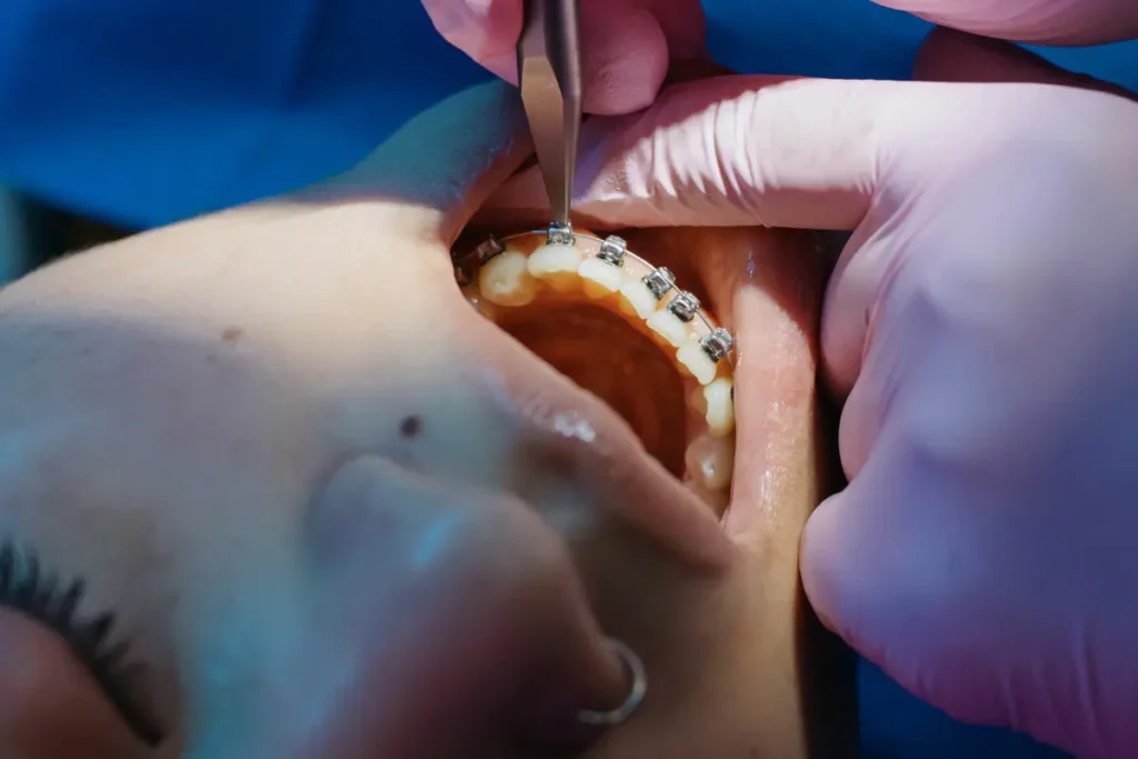 orthodontic emergency